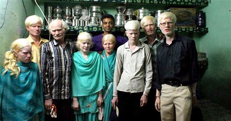 indian albinos|Jeevan Trust: Raising Awareness About Albinism in .